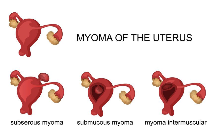 Lee más sobre el artículo Los miomas uterinos: ¿qué son?