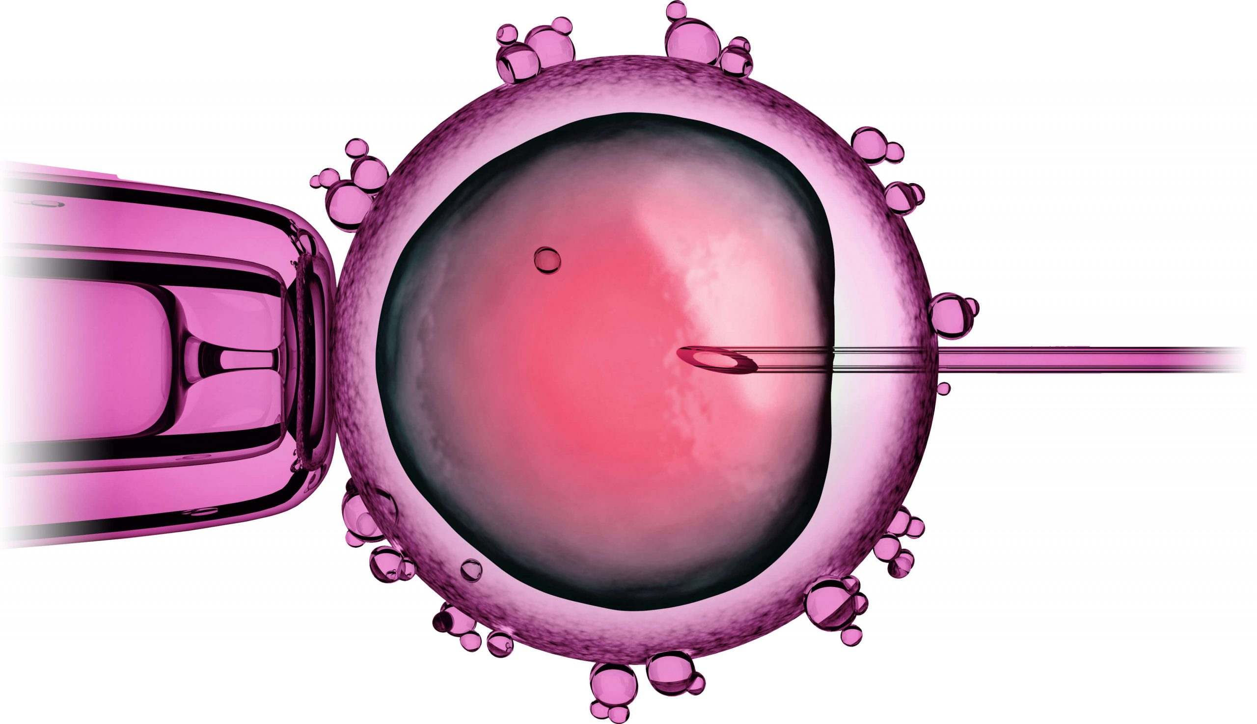 Lee más sobre el artículo Inyección intracitoplasmática de espermatozoides y la tasa de éxito